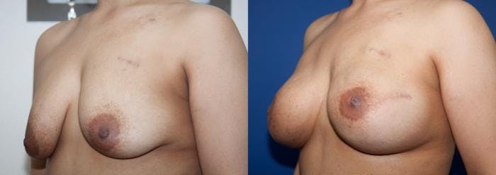 Breast Reconstruction Before & After Gallery - Patient 384077 - Image 2