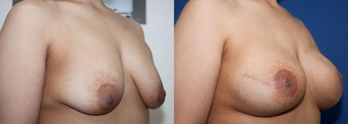 Breast Reconstruction Before & After Gallery - Patient 384077 - Image 3