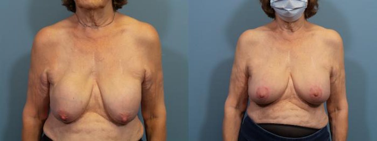Breast Reconstruction Before & After Gallery - Patient 223832 - Image 1