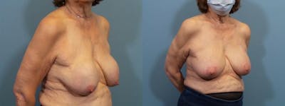 Breast Reconstruction Before & After Gallery - Patient 223832 - Image 2