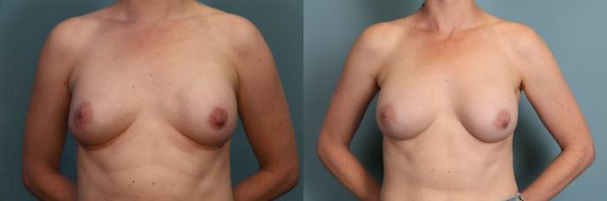Breast Reconstruction Before & After Gallery - Patient 168317 - Image 1