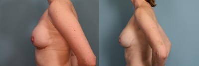 Breast Reconstruction Before & After Gallery - Patient 168317 - Image 2