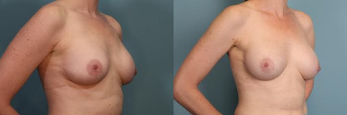 Breast Reconstruction Before & After Gallery - Patient 168317 - Image 3