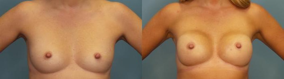 Breast Reconstruction Before & After Gallery - Patient 271066 - Image 1