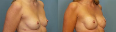 Breast Reconstruction Before & After Gallery - Patient 271066 - Image 2