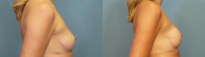 Breast Reconstruction Before & After Gallery - Patient 271066 - Image 3