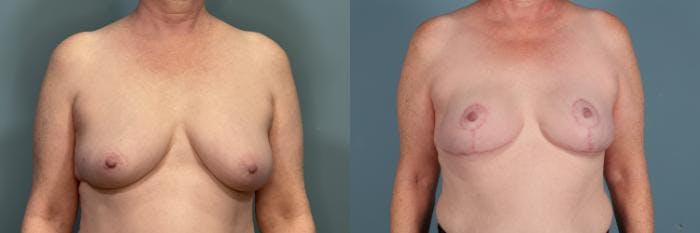 Breast Reconstruction Before & After Gallery - Patient 269413 - Image 1