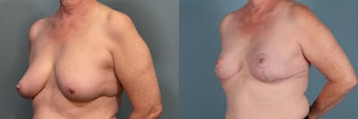 Breast Reconstruction Before & After Gallery - Patient 269413 - Image 2