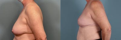 Breast Reconstruction Before & After Gallery - Patient 269413 - Image 3