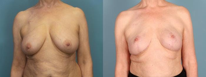 Breast Reconstruction Before & After Gallery - Patient 167528 - Image 1