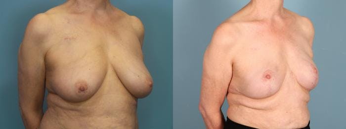 Breast Reconstruction Before & After Gallery - Patient 167528 - Image 2