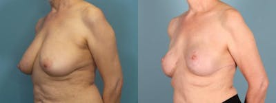 Breast Reconstruction Before & After Gallery - Patient 167528 - Image 3