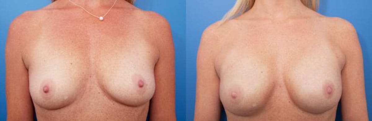 Breast Reconstruction Before & After Gallery - Patient 666091 - Image 1