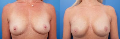 Breast Reconstruction Before & After Gallery - Patient 666091 - Image 1