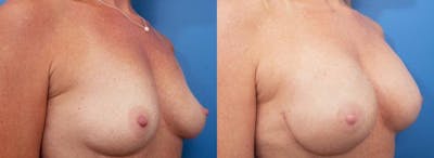 Breast Reconstruction Before & After Gallery - Patient 666091 - Image 2