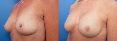 Breast Reconstruction Before & After Gallery - Patient 666091 - Image 3