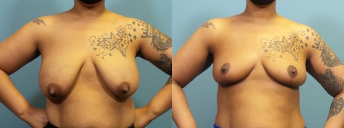 Breast Reconstruction Before & After Gallery - Patient 147928 - Image 1