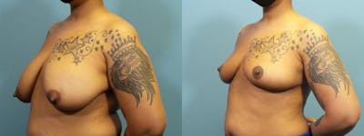 Breast Reconstruction Before & After Gallery - Patient 147928 - Image 2