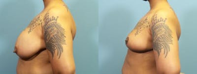Breast Reconstruction Before & After Gallery - Patient 147928 - Image 3