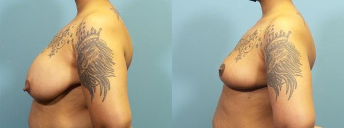Breast Reconstruction Before & After Gallery - Patient 147928 - Image 3