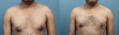 Male Breast Reduction (Gynecomastia) Before & After Gallery - Patient 113250 - Image 1