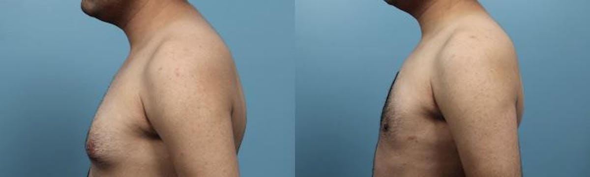 Male Breast Reduction (Gynecomastia) Before & After Gallery - Patient 113250 - Image 2
