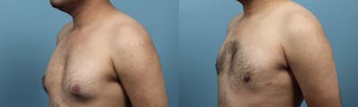 Male Breast Reduction (Gynecomastia) Before & After Gallery - Patient 113250 - Image 3