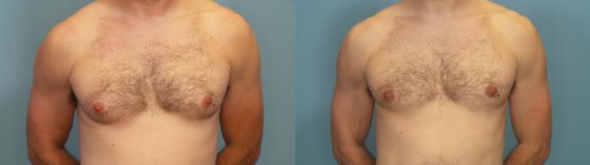 Male Breast Reduction (Gynecomastia) Before & After Gallery - Patient 684467 - Image 1