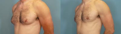 Male Breast Reduction (Gynecomastia) Before & After Gallery - Patient 684467 - Image 2