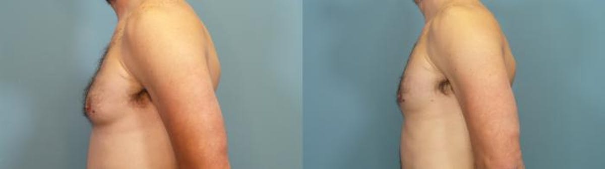 Male Breast Reduction (Gynecomastia) Before & After Gallery - Patient 684467 - Image 3