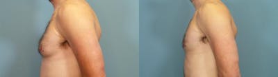 Male Breast Reduction (Gynecomastia) Before & After Gallery - Patient 684467 - Image 3