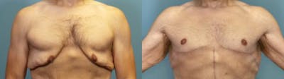 Male Breast Reduction (Gynecomastia) Before & After Gallery - Patient 800311 - Image 1