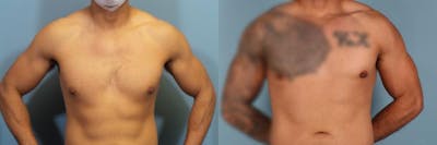 Male Breast Reduction (Gynecomastia) Before & After Gallery - Patient 418616 - Image 1