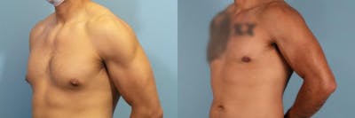 Male Breast Reduction (Gynecomastia) Before & After Gallery - Patient 418616 - Image 2