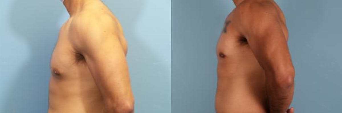 Male Breast Reduction (Gynecomastia) Before & After Gallery - Patient 418616 - Image 3