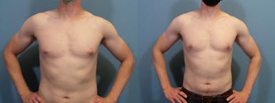Male Breast Reduction (Gynecomastia) Before & After Gallery - Patient 139949 - Image 1
