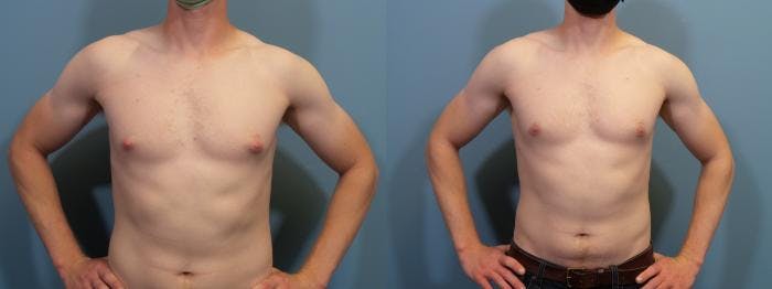 Male Breast Reduction (Gynecomastia) Before & After Gallery - Patient 139949 - Image 1