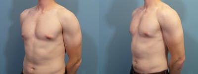 Male Breast Reduction (Gynecomastia) Before & After Gallery - Patient 139949 - Image 2