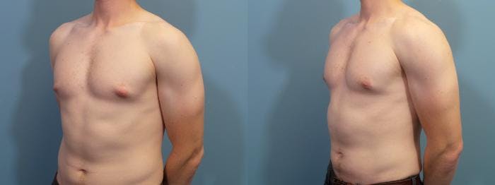 Male Breast Reduction (Gynecomastia) Before & After Gallery - Patient 139949 - Image 2