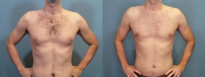Male Breast Reduction (Gynecomastia) Before & After Gallery - Patient 148626 - Image 1