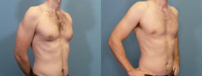 Male Breast Reduction (Gynecomastia) Before & After Gallery - Patient 148626 - Image 2