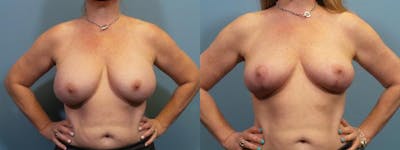 Breast Revision Before & After Gallery - Patient 397618 - Image 1