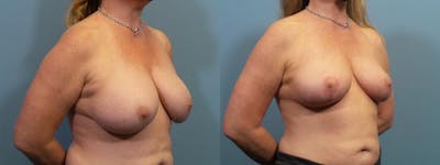 Breast Revision Before & After Gallery - Patient 397618 - Image 2
