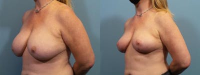 Breast Revision Before & After Gallery - Patient 397618 - Image 3