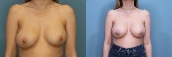 Breast Revision Before & After Gallery - Patient 314888 - Image 1