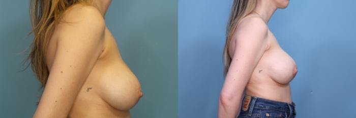 Breast Revision Before & After Gallery - Patient 314888 - Image 2