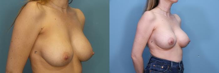 Breast Revision Before & After Gallery - Patient 314888 - Image 3
