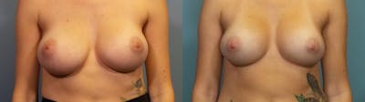 Breast Revision Before & After Gallery - Patient 256527 - Image 1