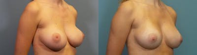 Breast Revision Before & After Gallery - Patient 256527 - Image 2