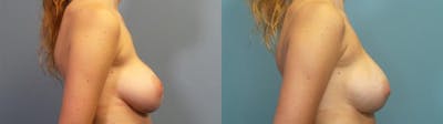 Breast Revision Before & After Gallery - Patient 256527 - Image 3